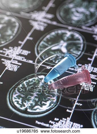 Stock Photography - Clinical samples from research project contained in vials with brain scan images, research into Alzheimers and dementia medical conditions.. Fotosearch