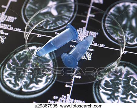Stock Photography - Clinical samples from research project contained in vials with brain scan images, research into Alzheimers and dementia medical conditions.. Fotosearch