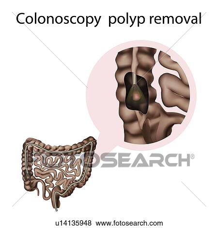 Colonoscopy polyp removal, illustration View Large Photo Image Stock Photo - Colonoscopy polyp removal, illustration. Fotosearch