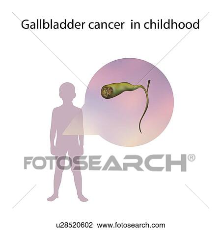 Stock Image - Gallbladder cancer in childhood, illustration. Fotosearch