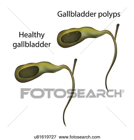 Stock Photo - Gallbladder polyps and healthy gallbladder, illustration. Fotosearch