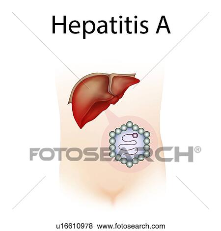 Hepatitis A, illustration View Large Photo Image Stock Photo - Hepatitis A, illustration. Fotosearch