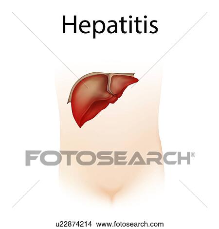 Picture - Hepatitis, illustration. Fotosearch