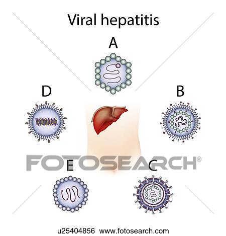 Hepatitis types A B C D E, illustration View Large Photo Image Stock Photograph - Hepatitis types A B C D E, illustration. Fotosearch