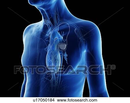 Picture - Illustration of an old man with a pace maker. Fotosearch