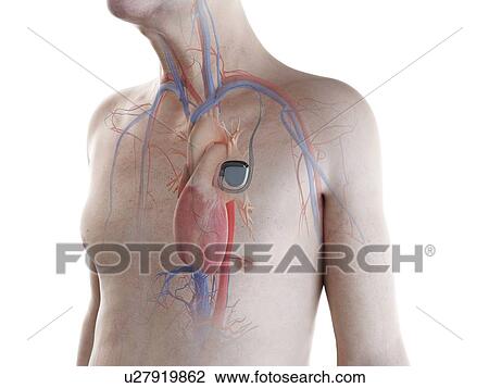 Illustration of an old man with a pace maker View Large Photo Image Stock Image - Illustration of an old man with a pace maker. Fotosearch