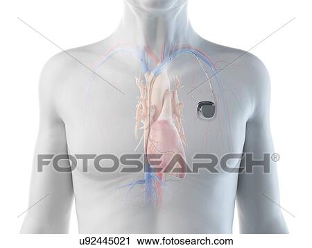 Stock Image - Illustration of an old man with a pace maker. Fotosearch