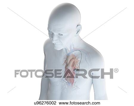 Illustration of an old man with a pace maker View Large Photo Image Stock Image - Illustration of an old man with a pace maker. Fotosearch