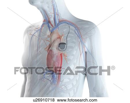 Illustration of an old man with a pace maker View Large Photo Image Stock Photo - Illustration of an old man with a pace maker. Fotosearch