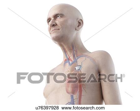 Illustration of an old man with a pace maker View Large Photo Image Stock Photo - Illustration of an old man with a pace maker. Fotosearch