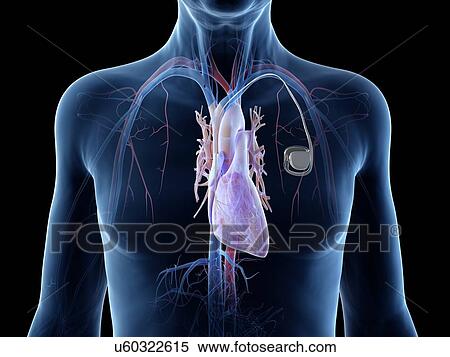 Stock Photography - Illustration of an old man with a pace maker. Fotosearch