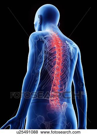 Stock Photo - Illustration of an old man's painful back. Fotosearch