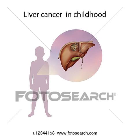 Liver cancer in childhood, illustration View Large Photo Image Stock Photo - Liver cancer in childhood, illustration. Fotosearch