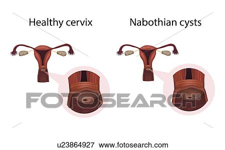 Nabothian cysts and healthy cervix, illustration View Large Photo Image Stock Photo - Nabothian cysts and healthy cervix, illustration. Fotosearch