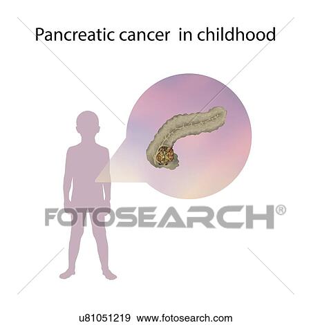Stock Photo - Pancreatic cancer in childhood, illustration. Fotosearch