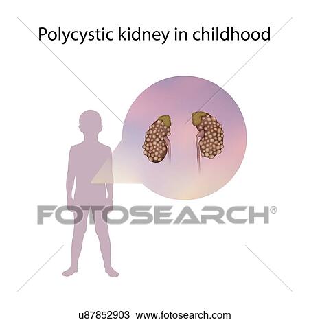 Stock Image - Polycystic kidney in childhood, illustration. Fotosearch