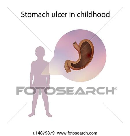 Stock Photo - Stomach ulcer in childhood, illustration. Fotosearch