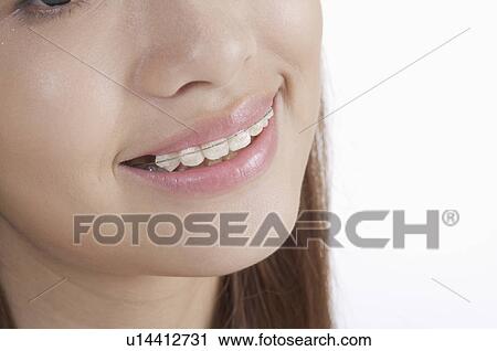 Stock Image - Close-up of young woman's braces. Fotosearch