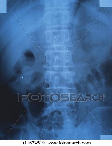 Stock Photo - X-ray of a human backbone. Fotosearch