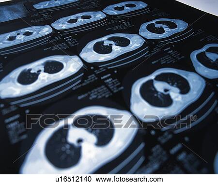 Stock Image - X-ray of a human stomach. Fotosearch