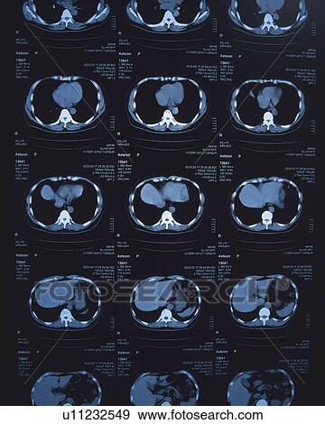 X-ray of a human stomach View Large Photo Image Stock Photo - X-ray of a human stomach. Fotosearch