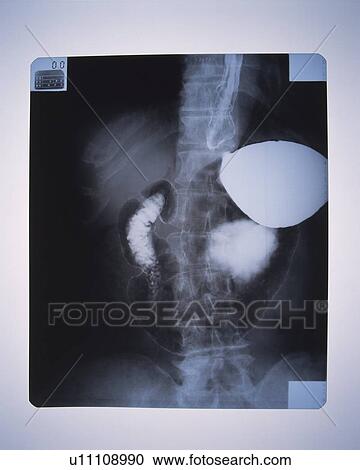 Stock Image - X-ray of human backbone with internal organs. Fotosearch