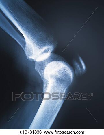 X-ray of human knee View Large Photo Image Stock Image - X-ray of human knee . Fotosearch