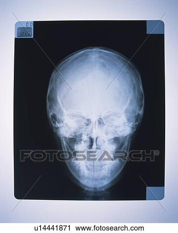 Stock Image - X-ray of human skull. Fotosearch