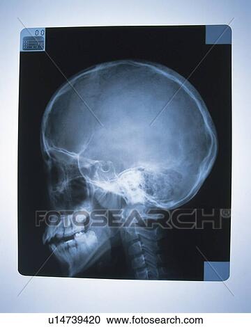 Stock Image - X-ray of human skull. Fotosearch