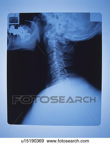 Stock Photo - X-ray of neck . Fotosearch