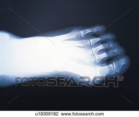 Stock Image - X-ray of the finger of foot. Fotosearch
