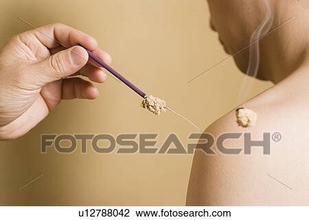 Stock Image - Doctor applying moxa. Fotosearch