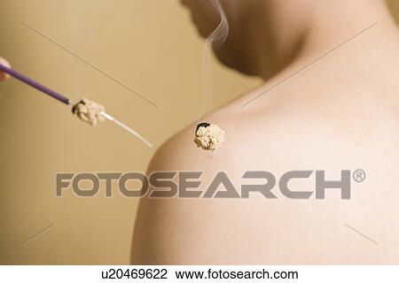 Doctor applying moxa View Large Photo Image Stock Image - Doctor applying moxa. Fotosearch