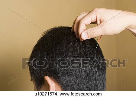 Doctor putting acupuncture needles on patient's head View Large Photo Image Picture - Doctor putting acupuncture needles on patient's head. Fotosearch