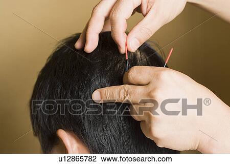 Stock Image - Doctor putting acupuncture needles on patient's head. Fotosearch