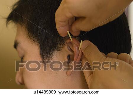 Stock Photo - Doctor putting acupuncture needles on patient's ear. Fotosearch