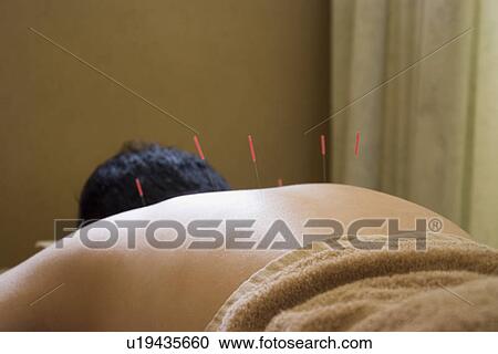 Stock Image - Man receiving acupuncture treatment. Fotosearch