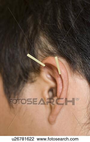 Stock Image - Man receiving acupuncture treatment. Fotosearch