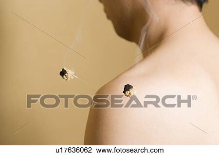 Stock Image - Patient receiving moxa treatment. Fotosearch