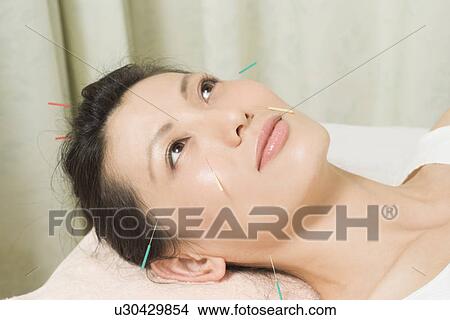 Picture - Woman receiving acupuncture treatment. Fotosearch