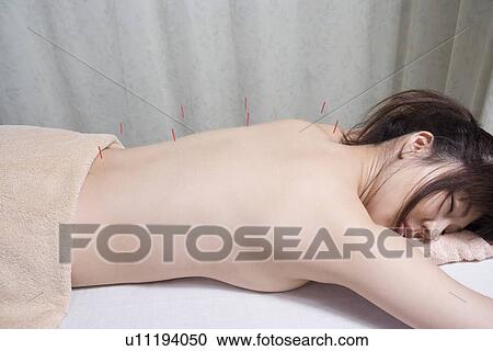 Stock Image - Woman receiving acupuncture treatment. Fotosearch