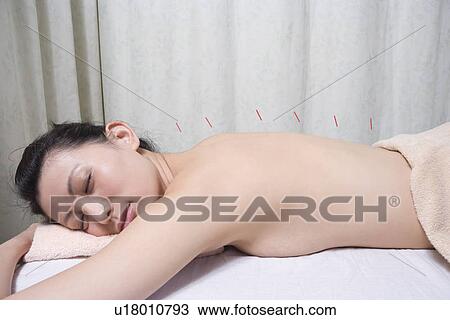 Stock Image - Woman receiving acupuncture treatment. Fotosearch