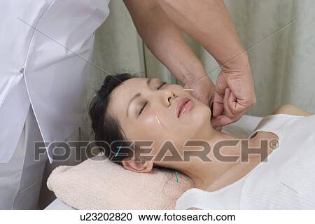 Stock Image - Woman receiving acupuncture treatment. Fotosearch