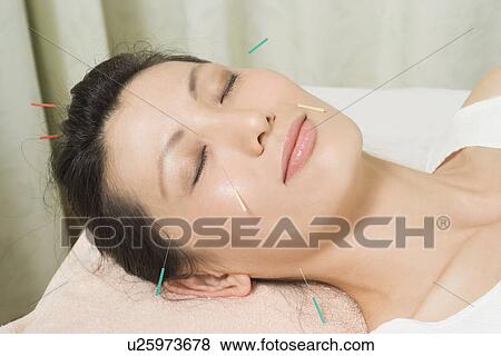 Stock Photo - Woman receiving acupuncture treatment. Fotosearch