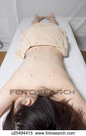 Woman receiving acupuncture treatment View Large Photo Image Stock Photography - Woman receiving acupuncture treatment. Fotosearch