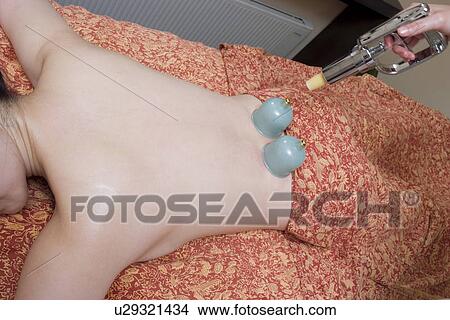 Young woman receiving cupping massage View Large Photo Image Picture - Young woman receiving cupping massage. Fotosearch
