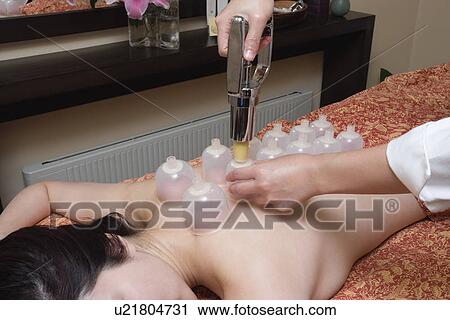 Stock Image - Young woman receiving cupping massage. Fotosearch