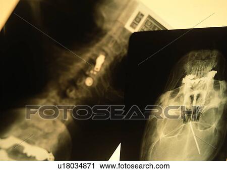 Stock Image - Close-Up, Full Frame, Human Bone. Fotosearch