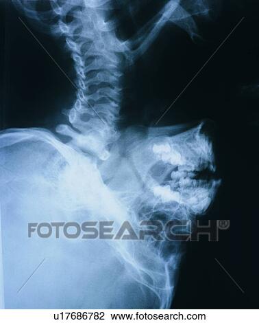 Black Background, Close-Up, Human Bone, Human Neck, Indoor View Large Photo Image Stock Image - Black Background, Close-Up, Human Bone, Human Neck, Indoor. Fotosearch