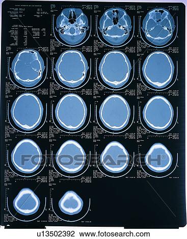 Stock Image - Black Background, Human Brain, Close-Up, Arrangement. Fotosearch